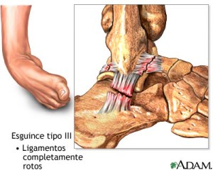 Esguince tratado de forma poco profesional